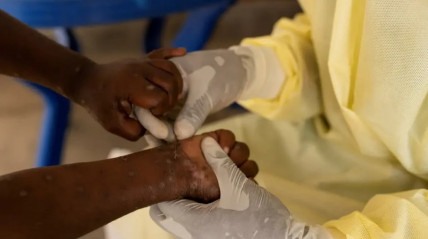 Casos de Mpox em África - DR