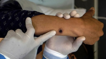 Detetado primeiro caso de nova variante de mpox nos EUA  - DR